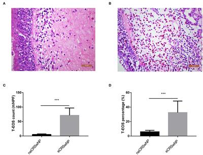 The Role of Serum Metabolomics in Distinguishing Chronic Rhinosinusitis With Nasal Polyp Phenotypes